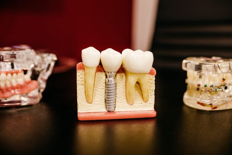 Modèle pédagogique d'un implant dentaire placé entre deux dents naturelles