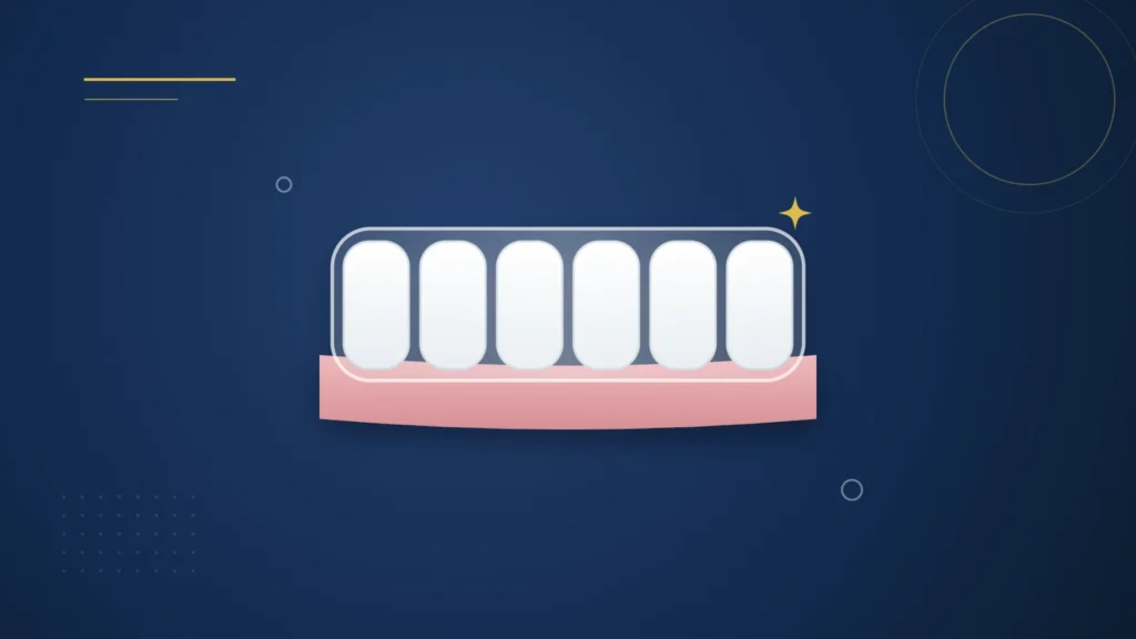 Illustration : une gouttière transparente d'alignement posée sur une rangée de dents
