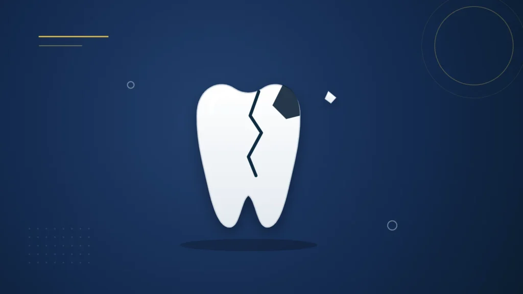 Illustration : une dent fêlée avec un fragment cassé