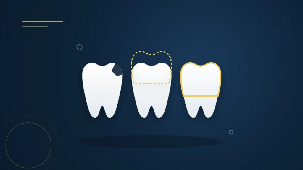 Illustration : trois dents de devant, une ébréchée, une avec une facette et une avec une couronne