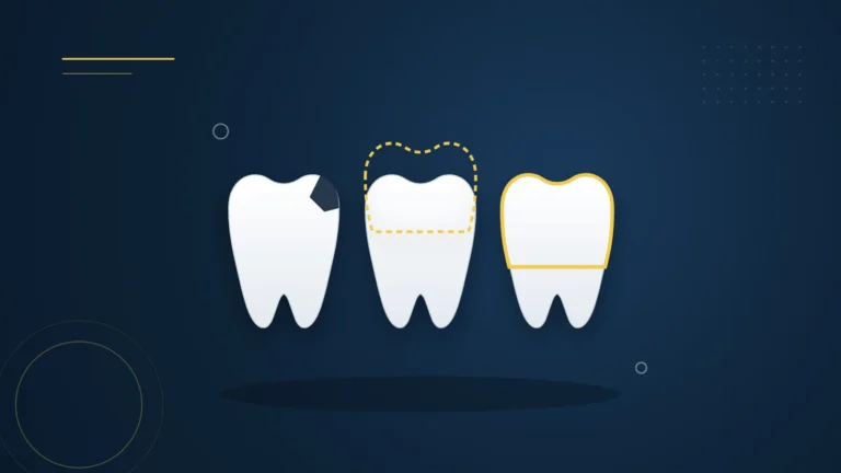 Illustration : trois dents de devant, une ébréchée, une avec une facette et une avec une couronne