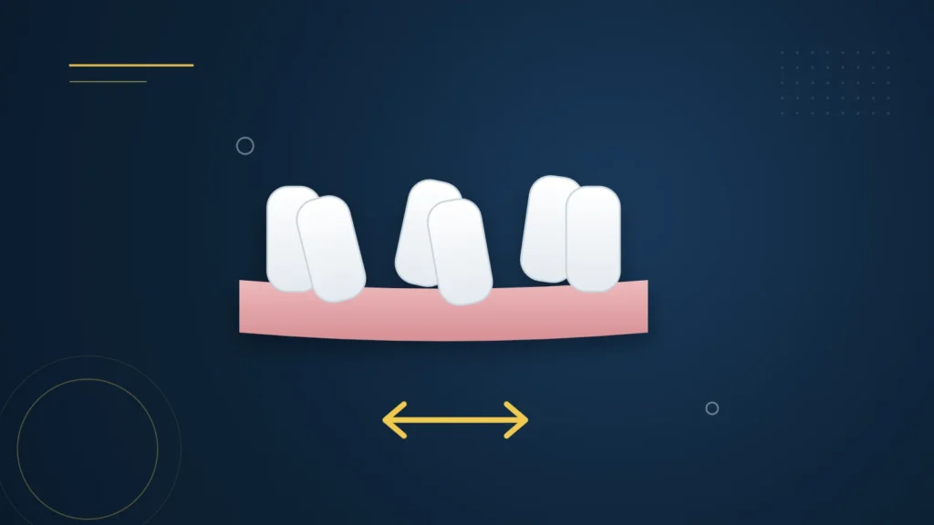 Illustration : des dents qui se chevauchent et des flèches indiquant l'alignement