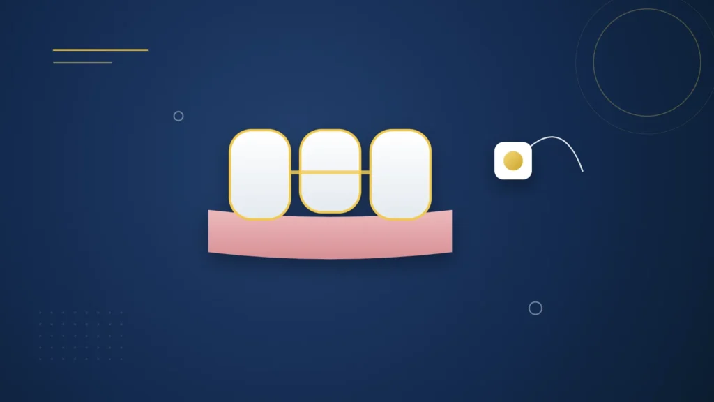 Illustration : un bridge dentaire de trois éléments et du fil dentaire