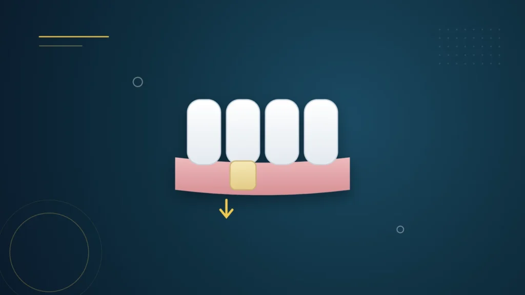 Illustration : des dents sur la gencive, l'une avec une racine découverte par une gencive rétractée
