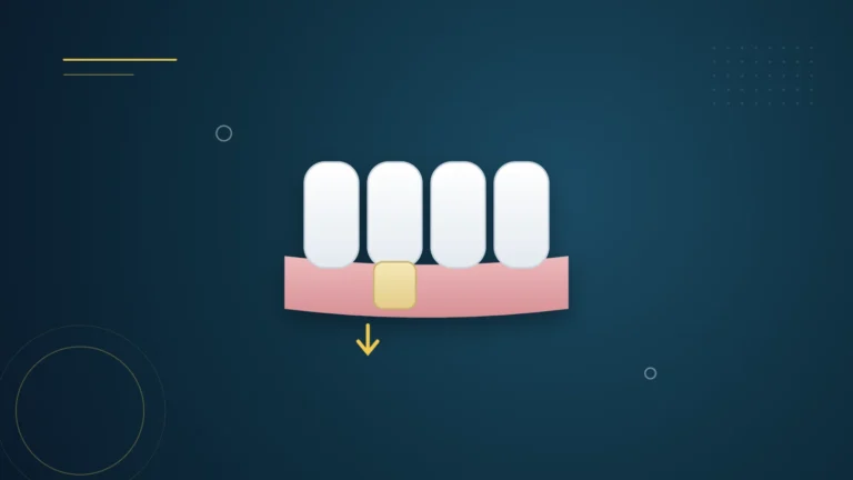 Illustration : des dents sur la gencive, l'une avec une racine découverte par une gencive rétractée