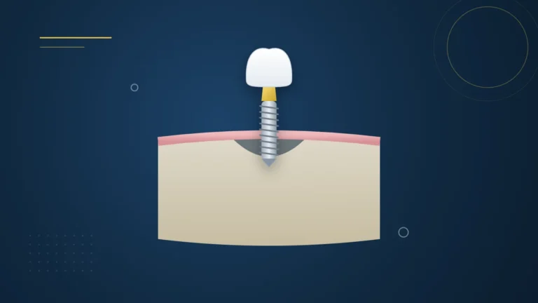 Illustration : un implant dentaire au-dessus d'un os de la mâchoire présentant un manque de volume