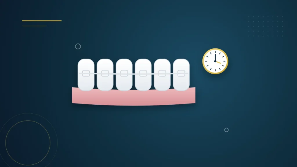 Illustration : des dents avec des bagues céramiques discrètes et une horloge