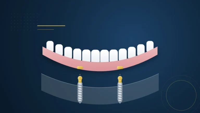 Illustration d'une prothèse dentaire amovible maintenue par deux implants munis d'attachements, sur fond bleu marine