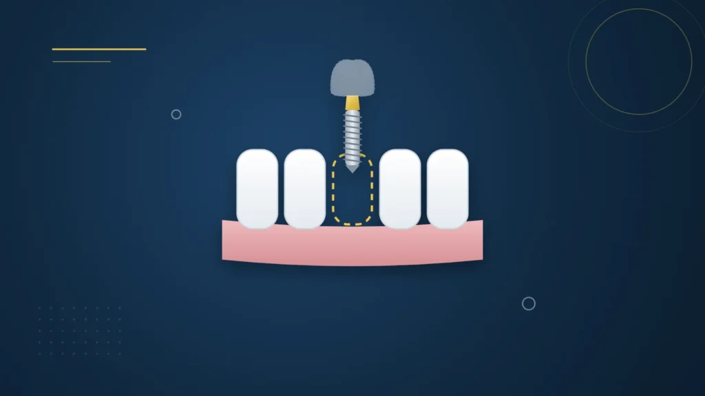 Illustration : une rangée de dents avec un espace à l'avant et un implant en pointillés