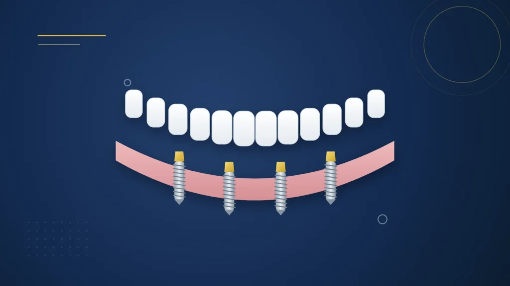 Illustration : une prothèse complète fixée sur quatre implants