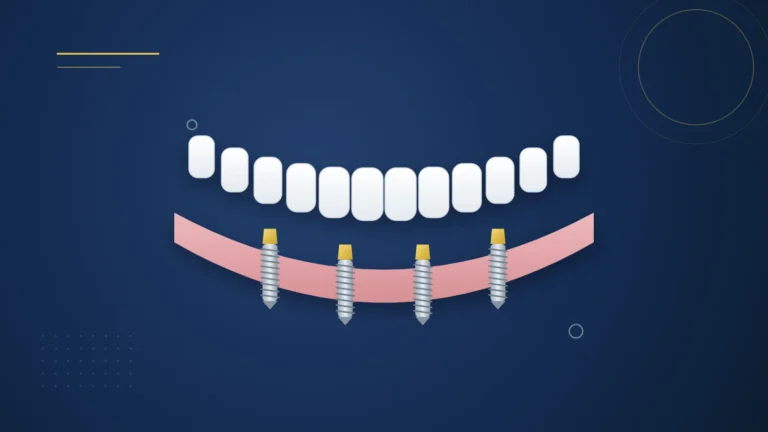 Illustration : une prothèse complète fixée sur quatre implants