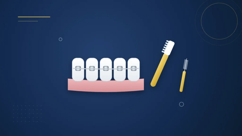 Illustration : des dents avec un appareil fixe, une brosse à dents et une brossette interdentaire